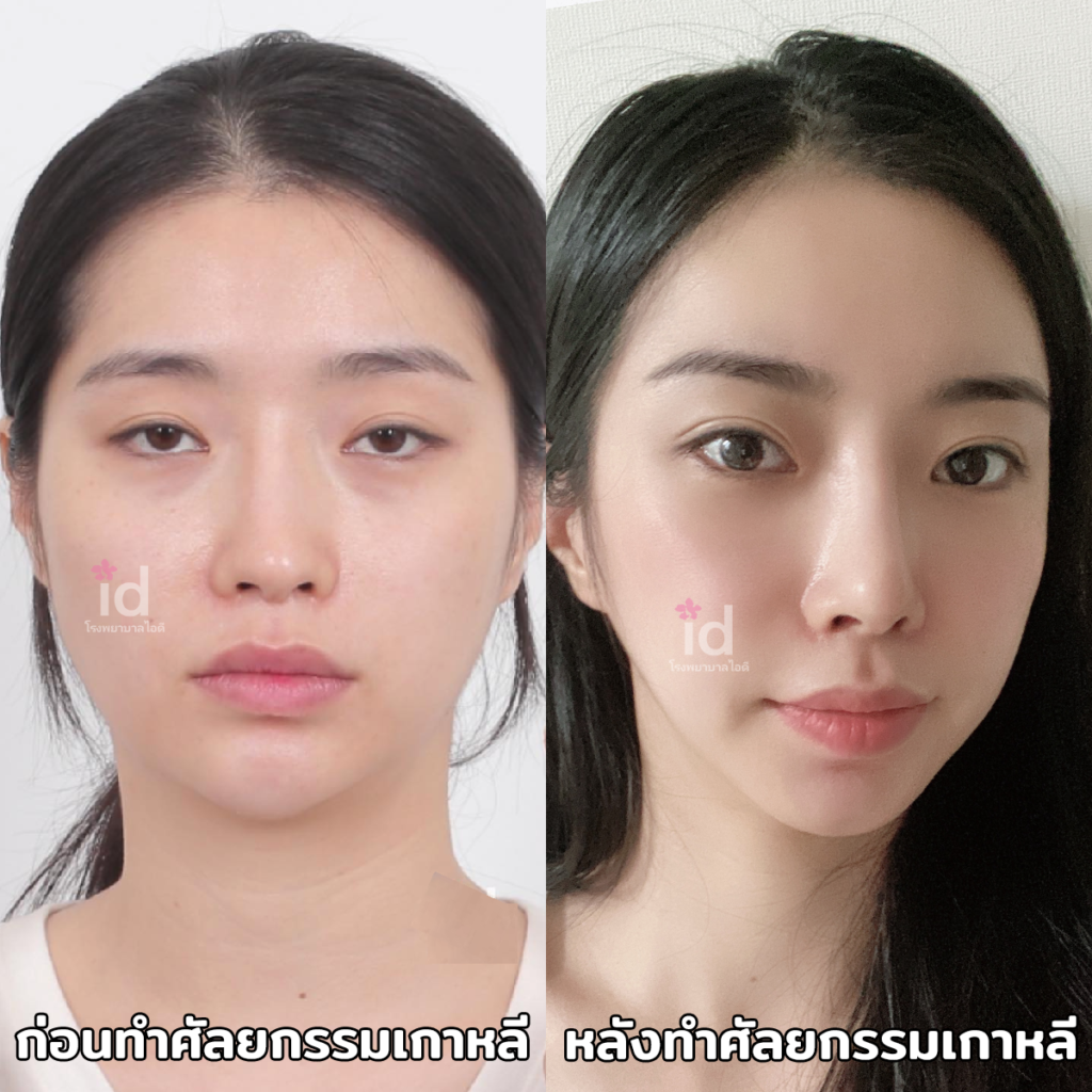 เทคนิคหน้าเรียว