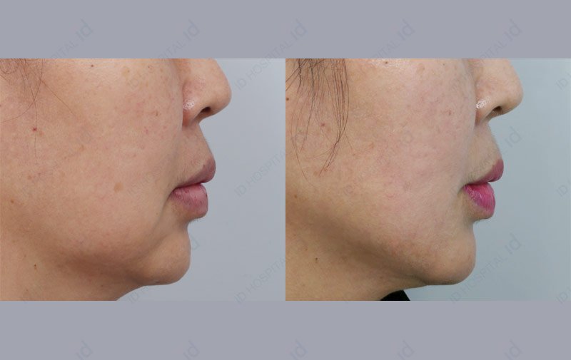 before-and-after11-21p_0007-1